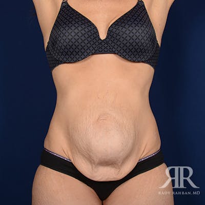 Severe Diastasis Recti Before & After Gallery - Patient 359096 - Image 1