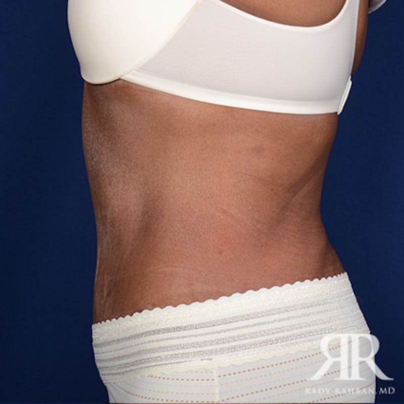 Body Lift Before & After Gallery - Patient 402969 - Image 6