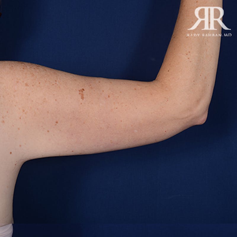 Arm Lift Before & After Gallery - Patient 377101 - Image 6