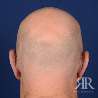 Ear Pinning Surgery Before & After Gallery - Patient 409602 - Image 8