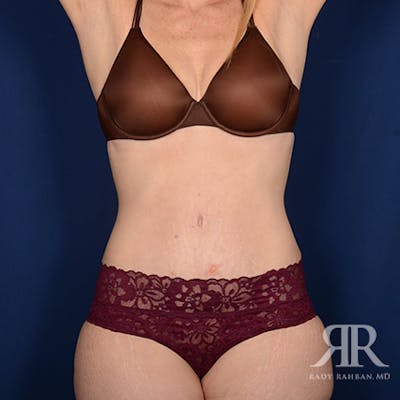Severe Diastasis Recti Before & After Gallery - Patient 359096 - Image 2
