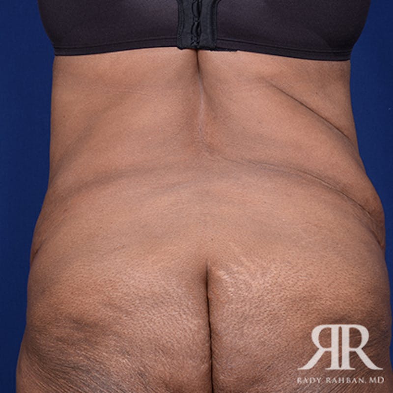 Body Lift Before & After Gallery - Patient 402969 - Image 7