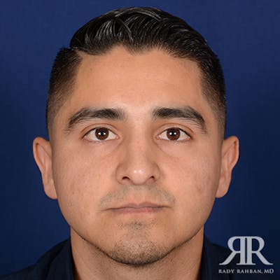 Corrective / Revision Rhinoplasty Before & After Gallery - Patient 247215 - Image 2