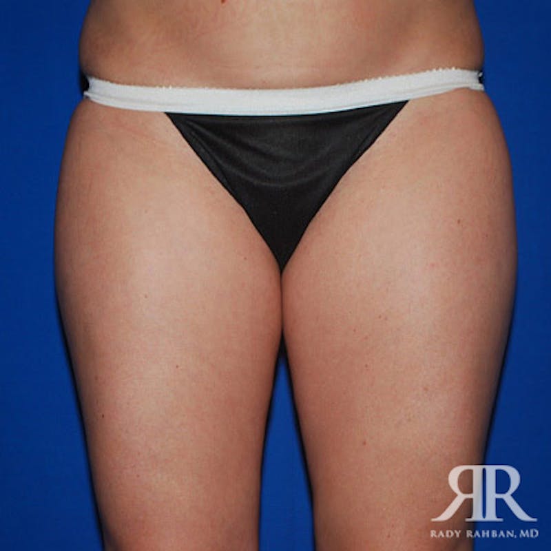 Liposuction Before & After Gallery - Patient 429296 - Image 1