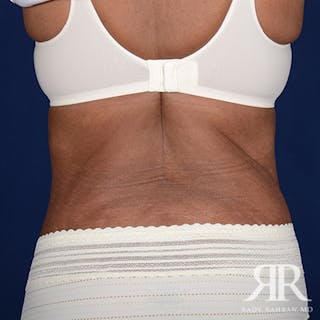 Body Lift Before & After Gallery - Patient 402969 - Image 8