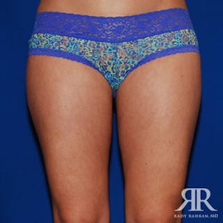 Liposuction Before & After Gallery - Patient 429296 - Image 2