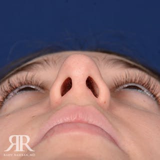 Rhinoplasty w/ Chin Implant Before & After Gallery - Patient 188860 - Image 8