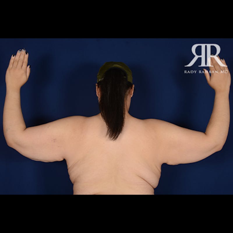 Arm Lift Before & After Gallery - Patient 358895 - Image 1