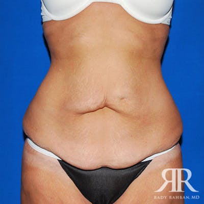 Body Lift Before & After Gallery - Patient 351499 - Image 1
