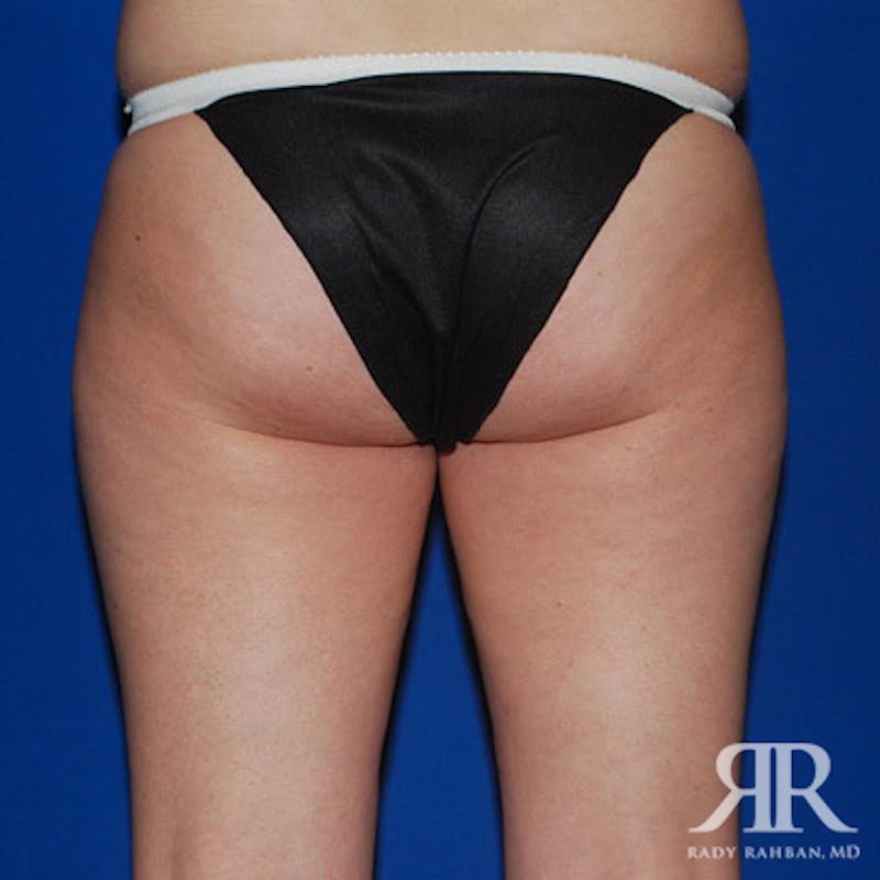 Liposuction Before & After Gallery - Patient 429296 - Image 3