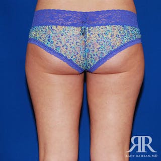 Liposuction Before & After Gallery - Patient 429296 - Image 4