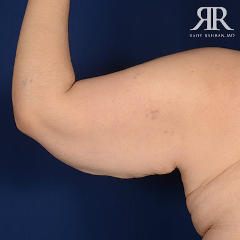 Arm Lift Before & After Gallery - Patient 358895 - Image 3
