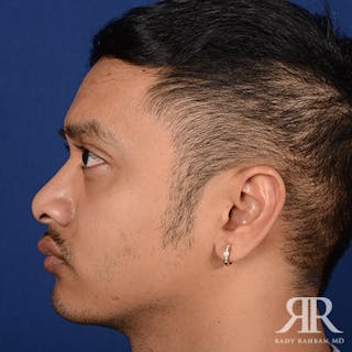 Chin Augmentation Before & After Gallery - Patient 323041 - Image 6
