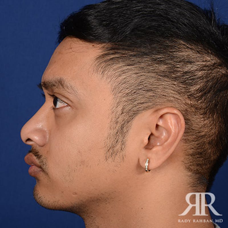 Chin Augmentation Before & After Gallery - Patient 323041 - Image 6