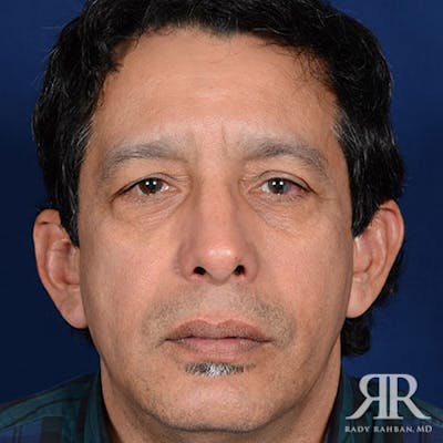 Rhinoplasty w/ Chin Implant Before & After Gallery - Patient 700282 - Image 2