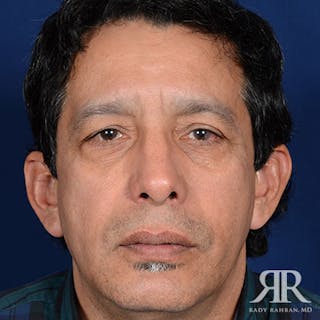 Rhinoplasty w/ Chin Implant Before & After Gallery - Patient 700282 - Image 2