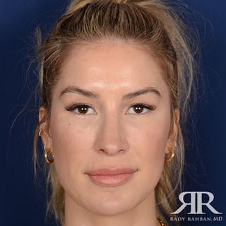 Female Rhinoplasty Before & After Gallery - Patient 378890 - Image 2