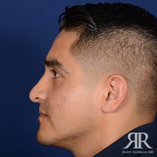 Corrective / Revision Rhinoplasty Before & After Gallery - Patient 247215 - Image 6
