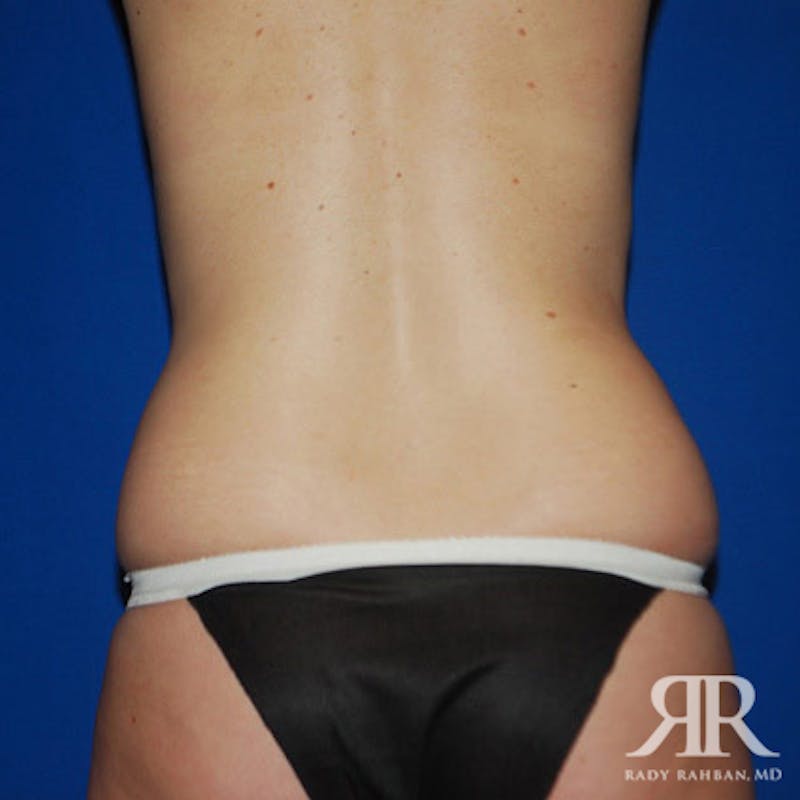 Liposuction Before & After Gallery - Patient 429296 - Image 5