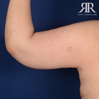 Arm Lift Before & After Gallery - Patient 358895 - Image 4