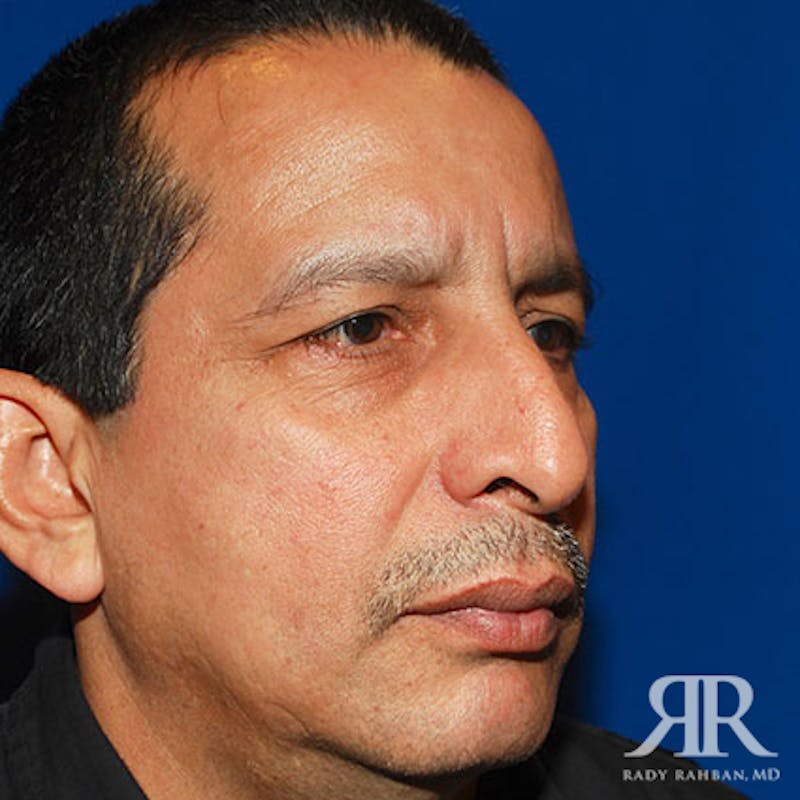Rhinoplasty w/ Chin Implant Before & After Gallery - Patient 700282 - Image 3