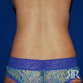 Liposuction Before & After Gallery - Patient 429296 - Image 6