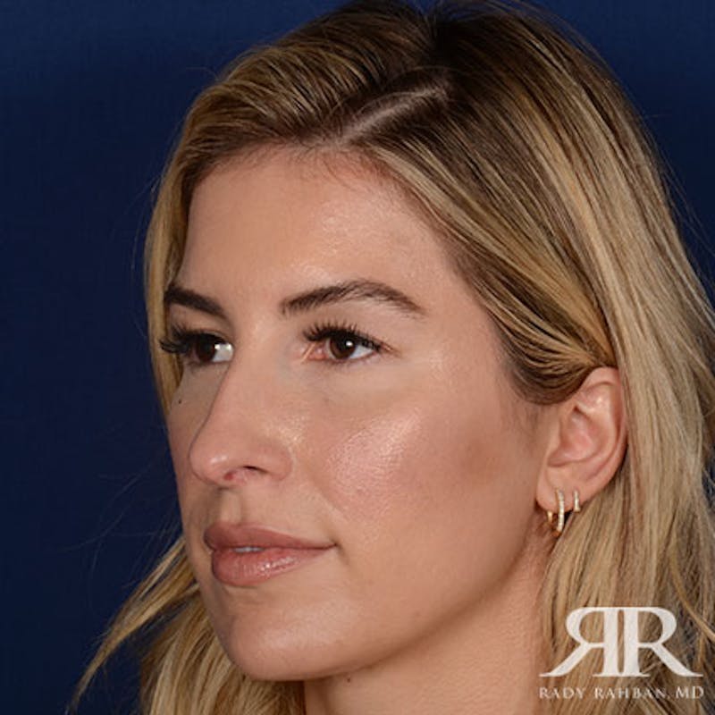 Female Rhinoplasty Before & After Gallery - Patient 378890 - Image 3