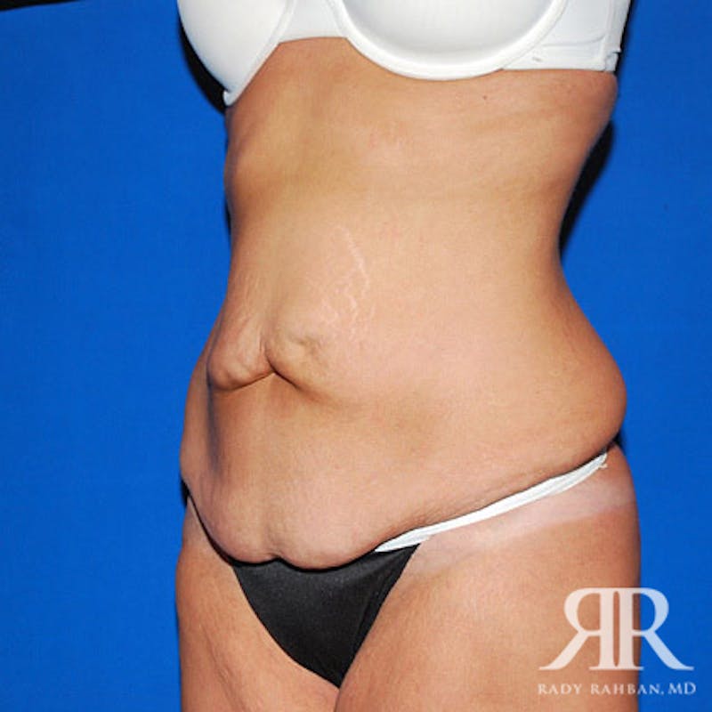 Body Lift Before & After Gallery - Patient 351499 - Image 3