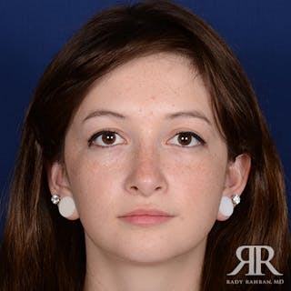 Ethnic Rhinoplasty Before & After Gallery - Patient 419069 - Image 2