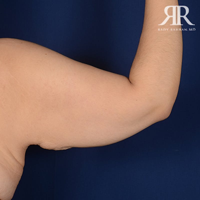 Arm Lift Before & After Gallery - Patient 358895 - Image 5