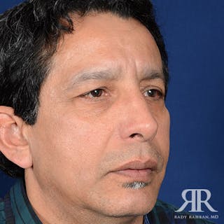 Rhinoplasty w/ Chin Implant Before & After Gallery - Patient 700282 - Image 4