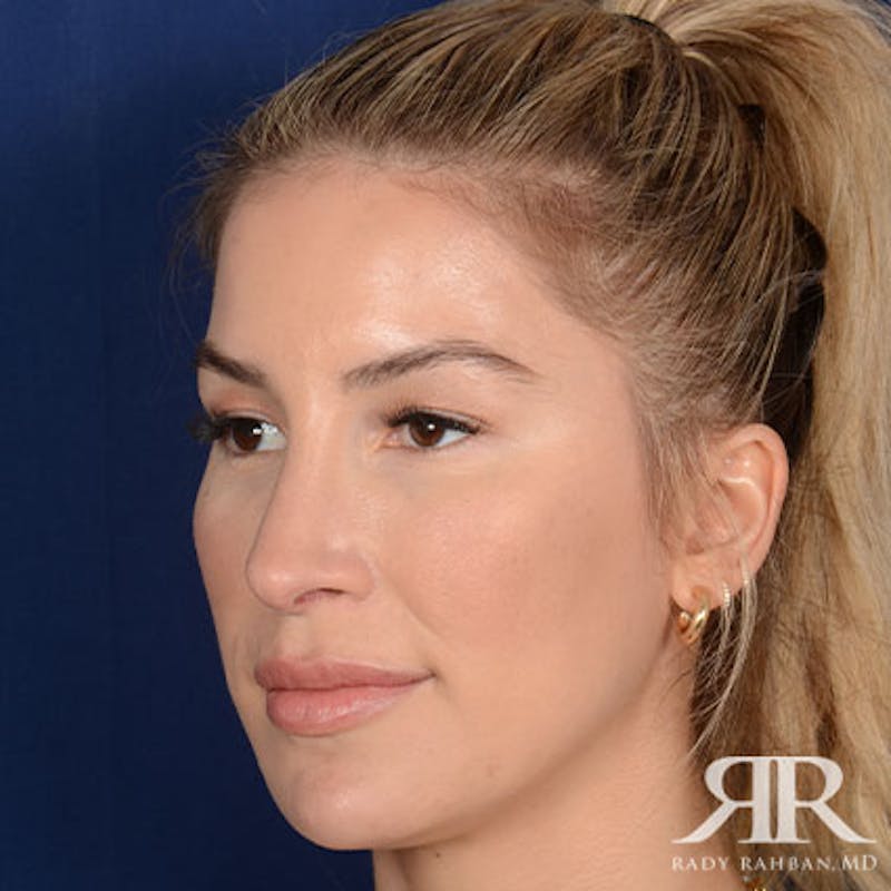 Female Rhinoplasty Before & After Gallery - Patient 378890 - Image 4