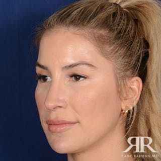 Female Rhinoplasty Before & After Gallery - Patient 378890 - Image 4