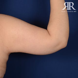 Arm Lift Before & After Gallery - Patient 358895 - Image 6