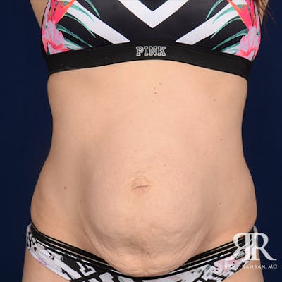 Severe Diastasis Recti Before & After Gallery - Patient 311161 - Image 1