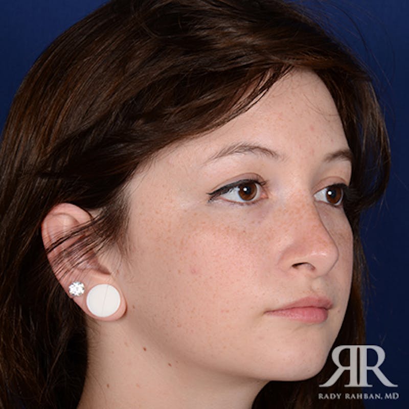 Ethnic Rhinoplasty Before & After Gallery - Patient 419069 - Image 4