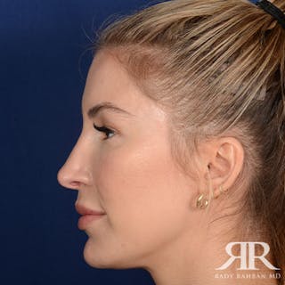 Female Rhinoplasty Before & After Gallery - Patient 378890 - Image 6