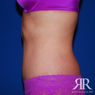 Body Lift Before & After Gallery - Patient 351499 - Image 6