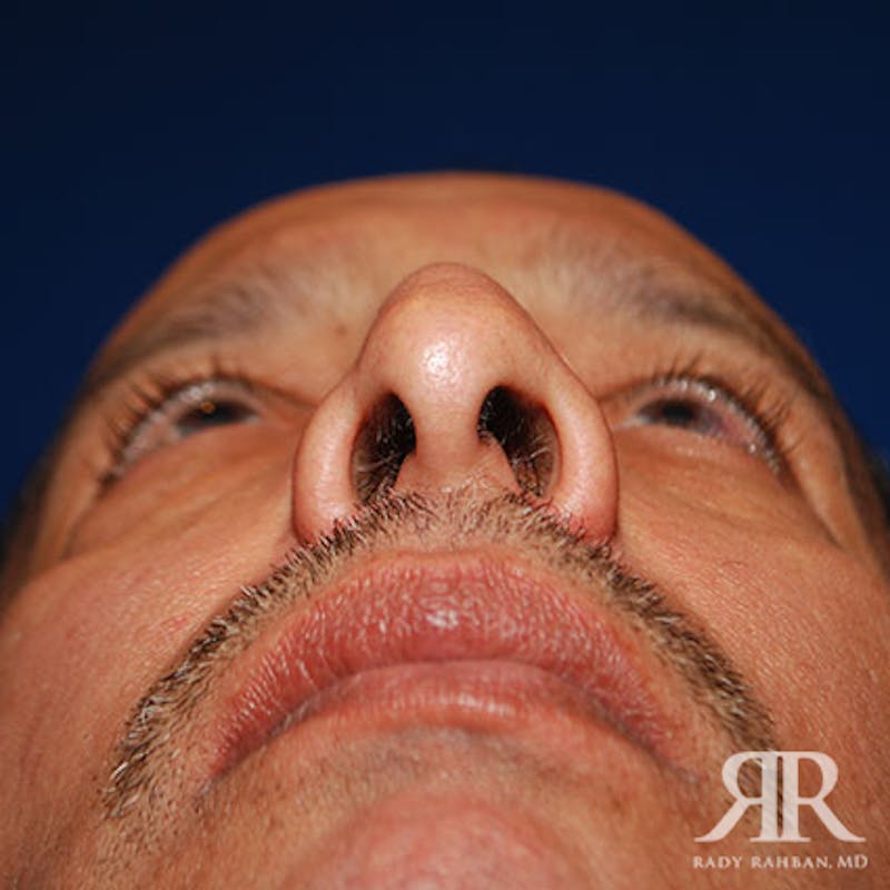 Rhinoplasty w/ Chin Implant Before & After Gallery - Patient 700282 - Image 7