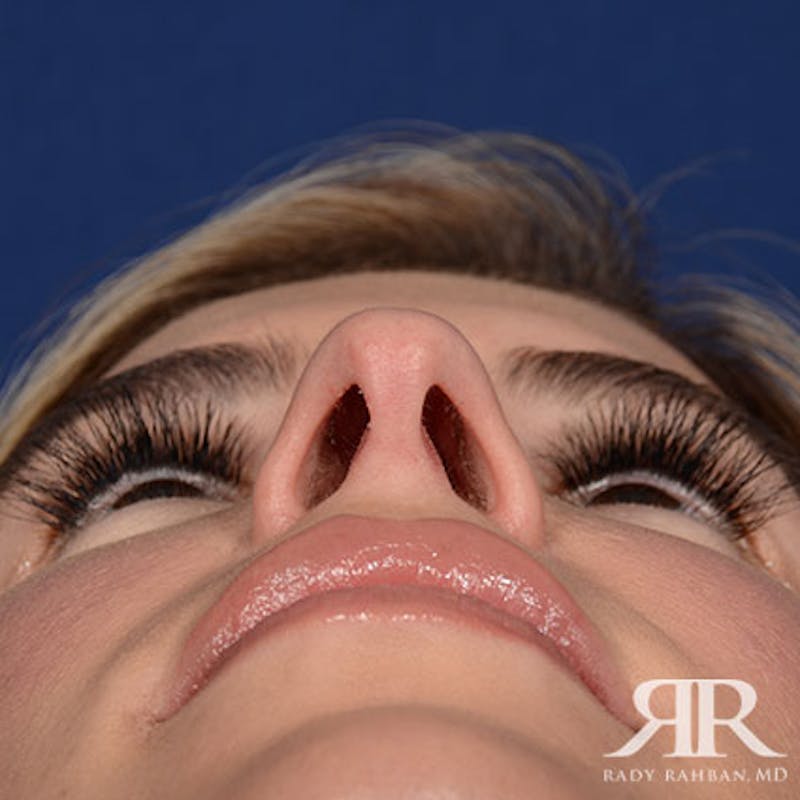 Female Rhinoplasty Before & After Gallery - Patient 378890 - Image 7