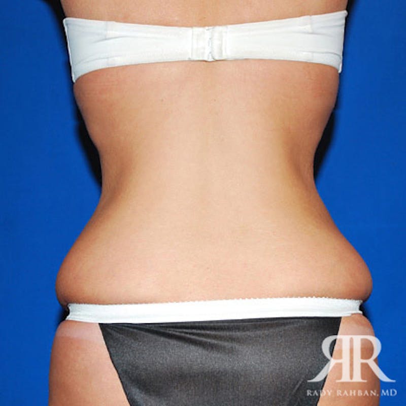 Body Lift Before & After Gallery - Patient 351499 - Image 7