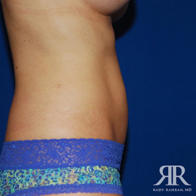 Liposuction Before & After Gallery - Patient 429296 - Image 8