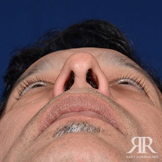 Rhinoplasty w/ Chin Implant Before & After Gallery - Patient 700282 - Image 8