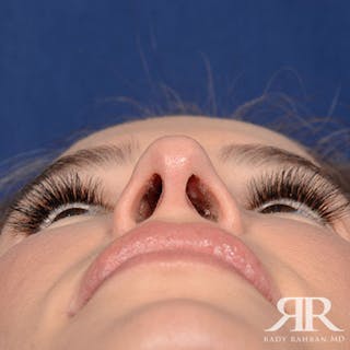 Female Rhinoplasty Before & After Gallery - Patient 378890 - Image 8