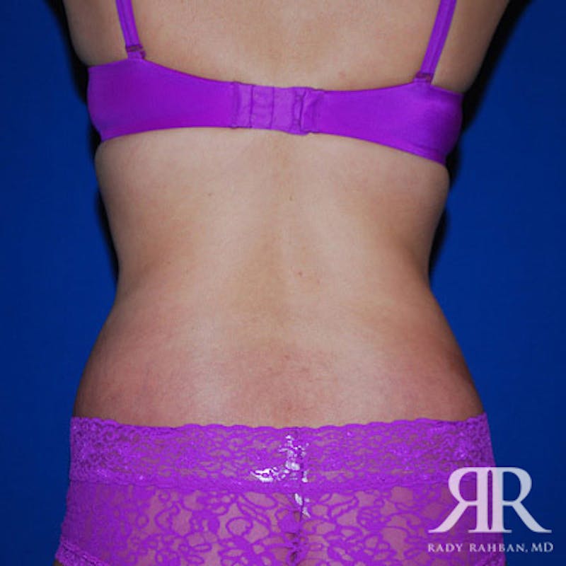 Body Lift Before & After Gallery - Patient 351499 - Image 8