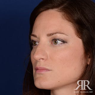 Corrective / Revision Rhinoplasty Before & After Gallery - Patient 224330 - Image 4