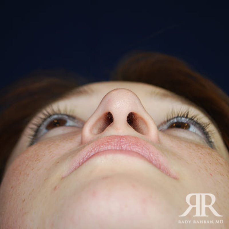Ethnic Rhinoplasty Before & After Gallery - Patient 419069 - Image 7