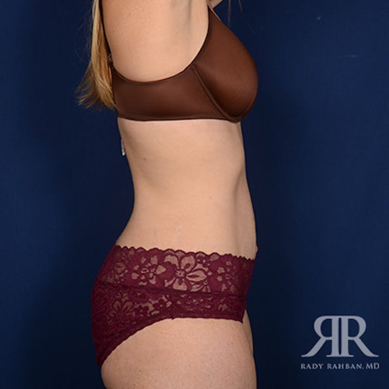 Tummy Tuck Before & After Gallery - Patient 220525 - Image 6