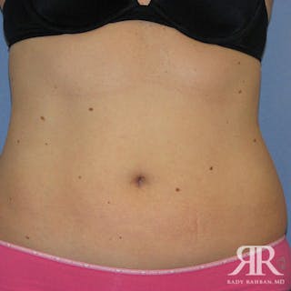 Liposuction Before & After Gallery - Patient 880408 - Image 2