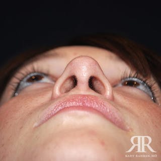 Ethnic Rhinoplasty Before & After Gallery - Patient 419069 - Image 8